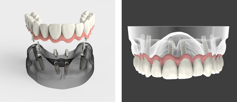 Dental Implants