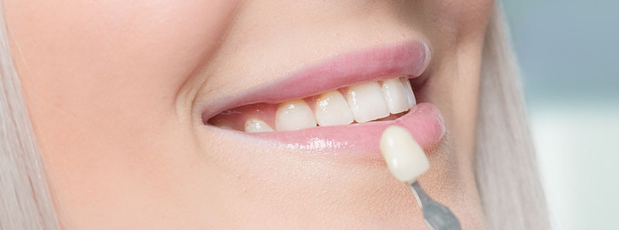 Dental veneers in Viera, FL are an ideal choice.