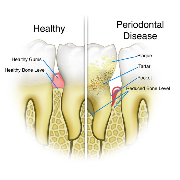 Periodontal (Gum) Treatments - Dental Services